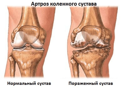 Доктор мясников лечение коленных суставов