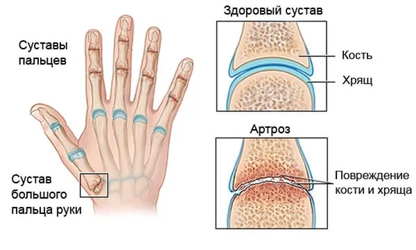 Отеки пальцев рук причины, лечение
