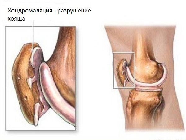 Почему возникает боль в мышцах ног выше колена, и как от нее избавиться