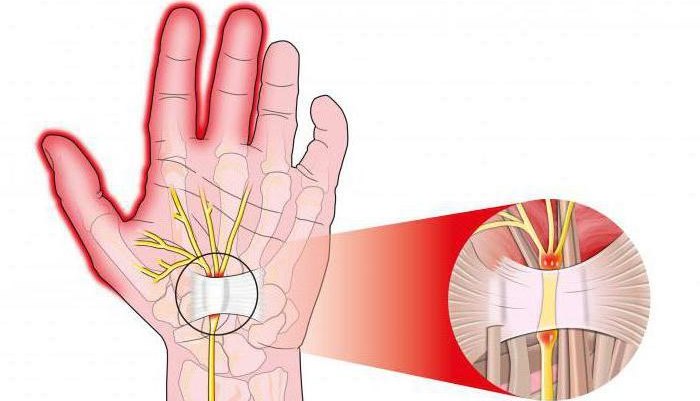 Болят суставы пальцев рук при беременности причины боли в кистях