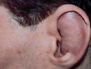 Гематома уха у собаки причины и лечение