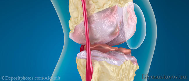 Коленный сустав изношена хрящевая ткань как восстановить