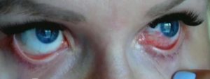 Химический ожог глаза после наращивания ресницХимический ожог глаза после наращивания ресниц первая помощь и лечениеПроявления химического ожога глаз и действенное лечение в домашних условияхКак быстро и правильно вылечить химический ожог глазаХимический