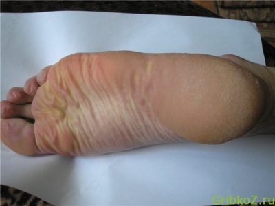 Доктор мясников о грибке ногтей на ногах