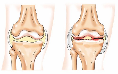 Остеофиты коленного сустава лечение