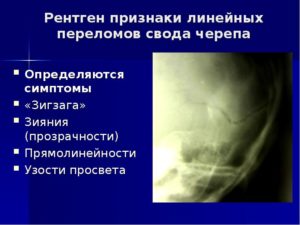 Последствия перелома теменной кости у ребенкаПоследствия перелома теменной кости у ребенка