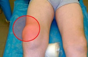 Выпот в полости коленного сустава лечение и виды синовитов