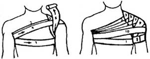 Колосовидная повязка на плечевой сустав техника наложения, сроки использования