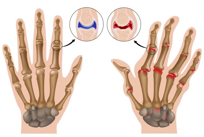 Полиартрит пальцев и кистей рук лечение народными средствами и симптомы