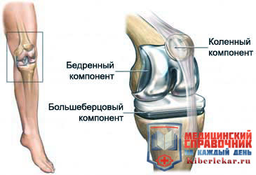 Возможные осложнения после замены коленного сустава