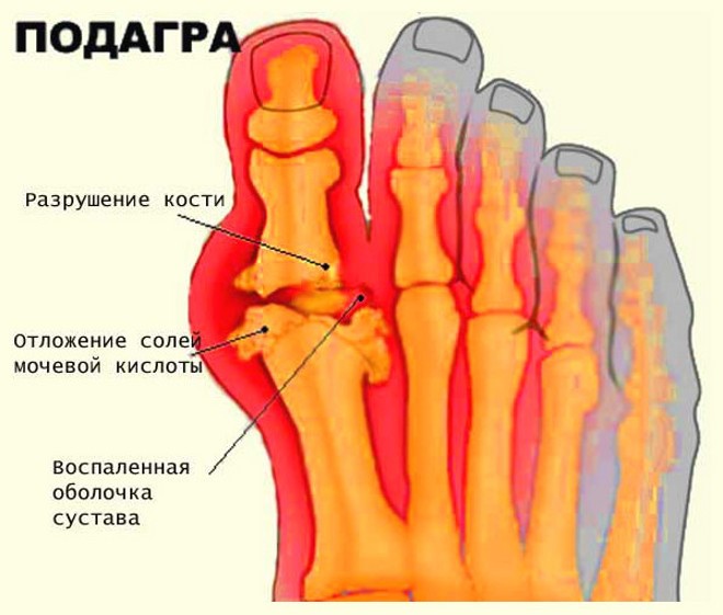 Физиотерапия при артрите коленного сустава
