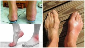 Остеохондроз ноги признаки, симптомы и эффективное лечение