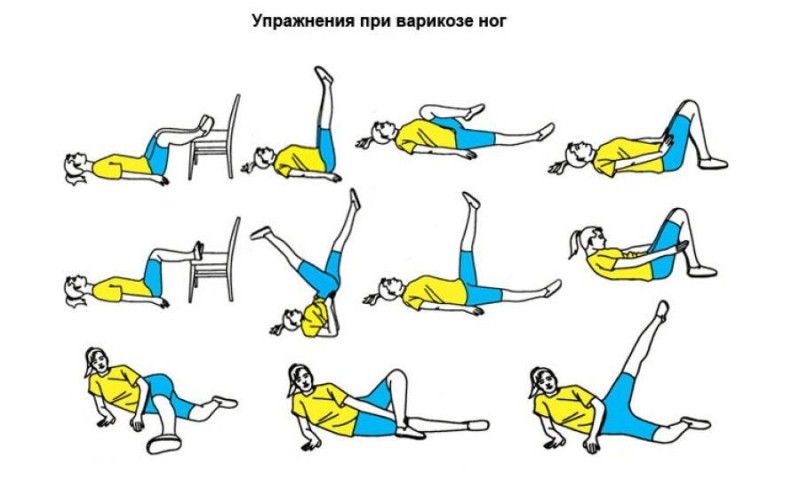 Лечебная гимнастика при варикозном расширении вен нижних конечностей