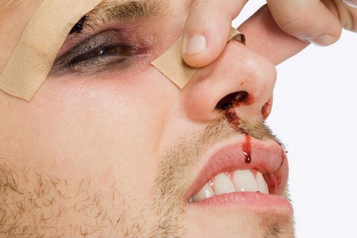 Репозиция перелома костей носа после травмы видео, фото, последствия