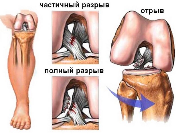 Разрыв крестообразной связки коленного сустава симптомы, виды, лечение