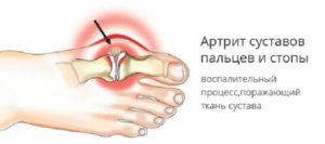 Симптомы и особенности лечения артрита пальцев ног