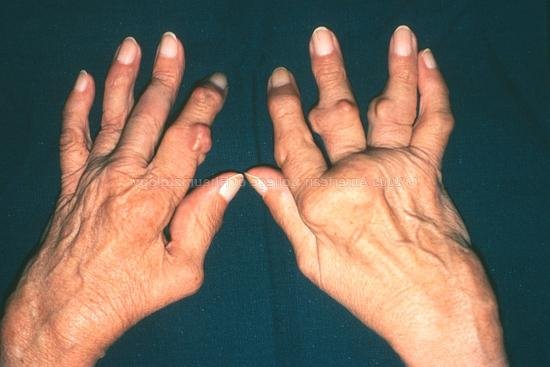 Что делать при воспалении сустава на пальце руки