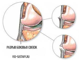 Симптомы и лечение надрыва коленных связок