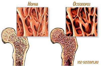 Как лечить остеопороз тазобедренного сустава
