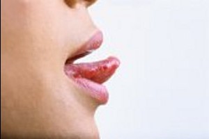 Может ли быть жжение и онемение языка при шейном остеохондрозе