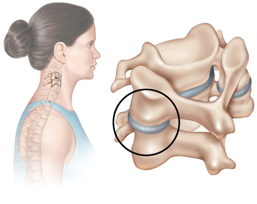 Причины боли в руке при остеохондрозе шейного отдела