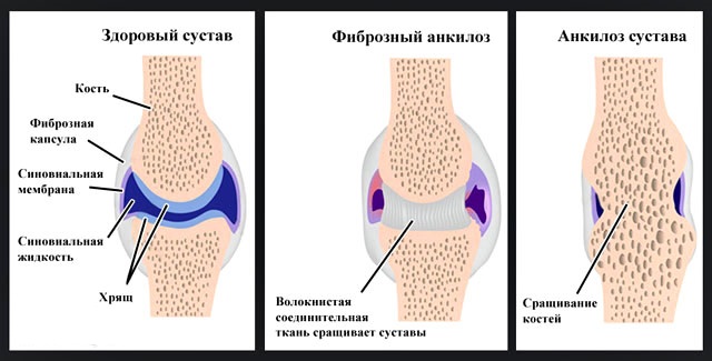 Рентгенологические стадии ревматоидного артрита