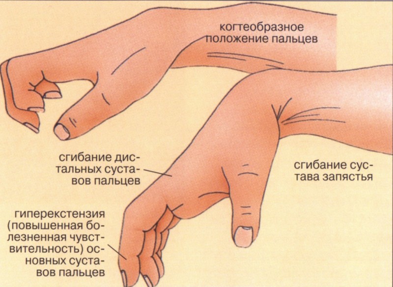 Ушибы кистевого сустава и суставов пальцев кисти