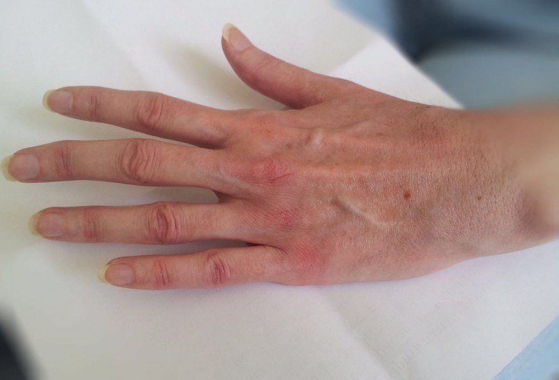 Полиартрит пальцев и кистей рук лечение народными средствами и симптомы