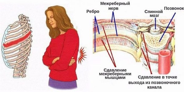 Невралгия грудного отдела позвоночника