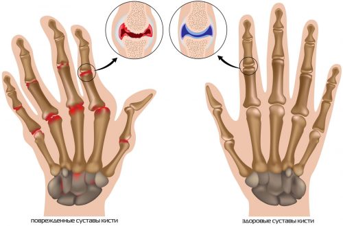Почему возникает артрит запястья руки и как его вылечить