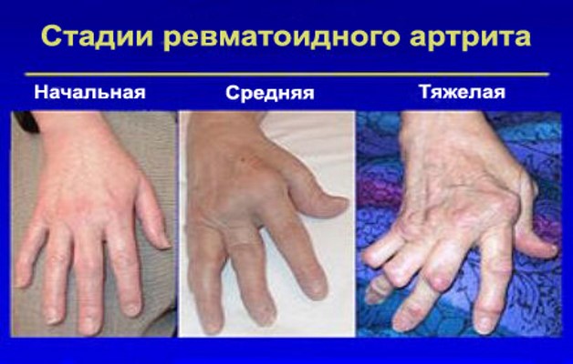 Скованность суставов пальцев рук по утрам