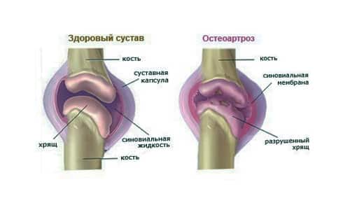 Как лечить остеоартроз суставов стопы
