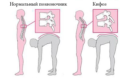 Упражнения при кифосколиозе грудного отдела позвоночника
