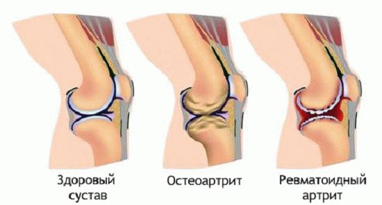 Лечение заболеваний суставов спорт при ревматоидном артрите