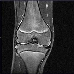 УЗИ рентген или МРТ коленного сустава что лучше выбрать