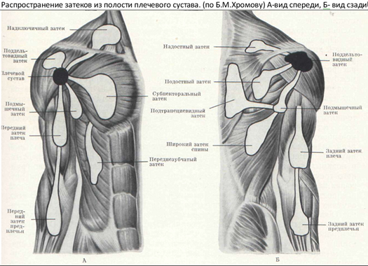 Лечение бурсита плечевого сустава воспаление синовиальной сумки плеча
