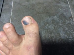 Как убрать синяк под ногтем большого пальца ноги