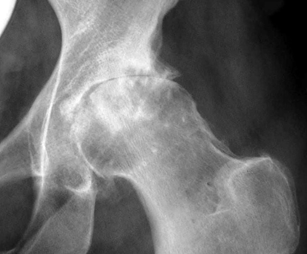 Как лечить остеопороз тазобедренного сустава
