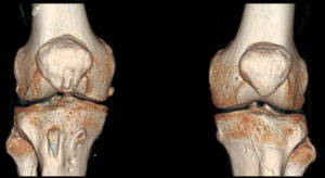 КТ коленного и других суставов как подготовится и сколько длится компьютерная томография