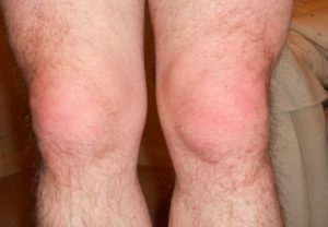 Горят колени причины, что это может быть, если горячие ноги, лечение