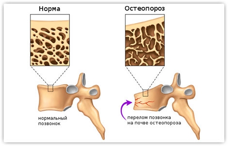 Различные физиотерапии при остеопорозе