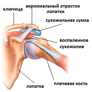 Разрыв надостной мышцы плеча