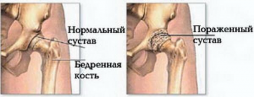 Остеоартроз суставов