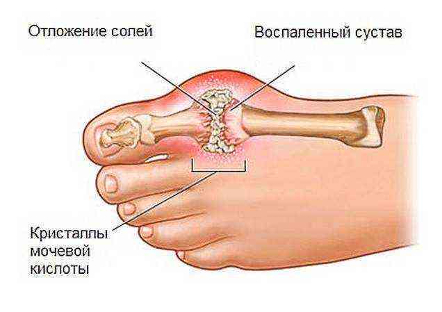 Воспаление косточки на большом пальце ноги лечение народными средствами
