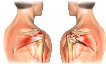 Упражнения для плечевого сустава лечение боль в плече shoulder pain exercise guide