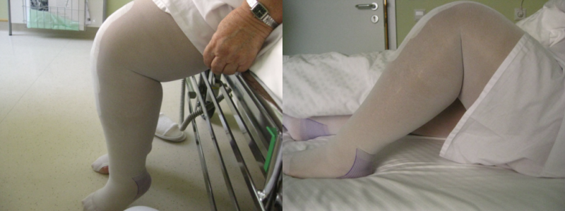 Отек коленного сустава после операции