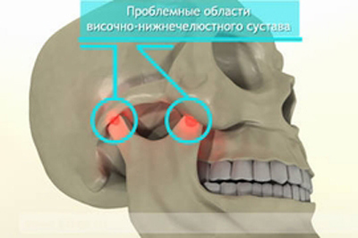 Как лечить артроз челюстно лицевого сустава