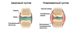 Повреждение мениска коленного сустава 3 степени