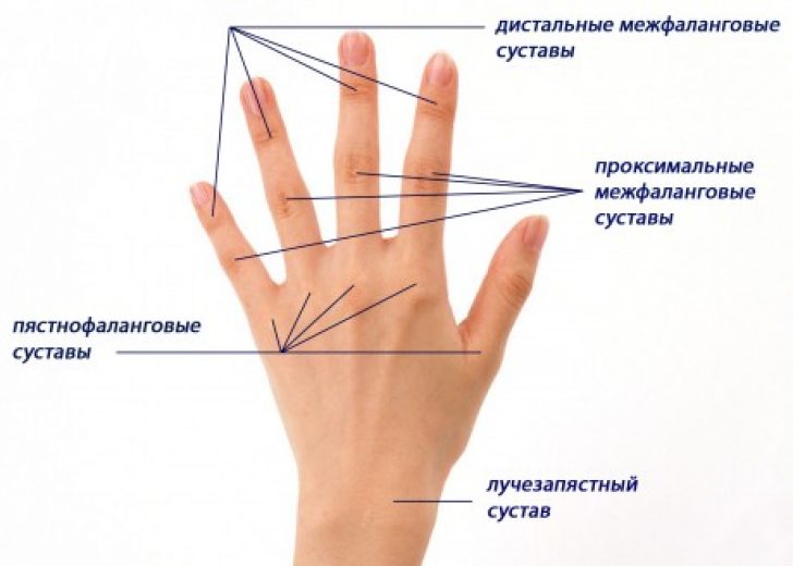 Почему возникает артрит запястья руки и как его вылечить
