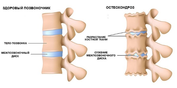 Комплекс упражнений при остеохондрозе шейного отдела позвоночника с палкой